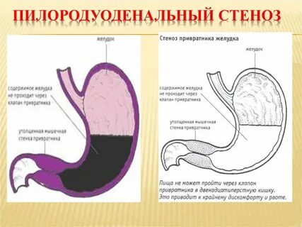 Пилородуоденальный стеноз