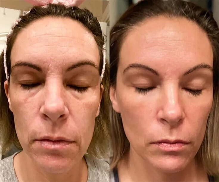 Фотоомоложение фото до и после процедуры: найдено 87 изображений