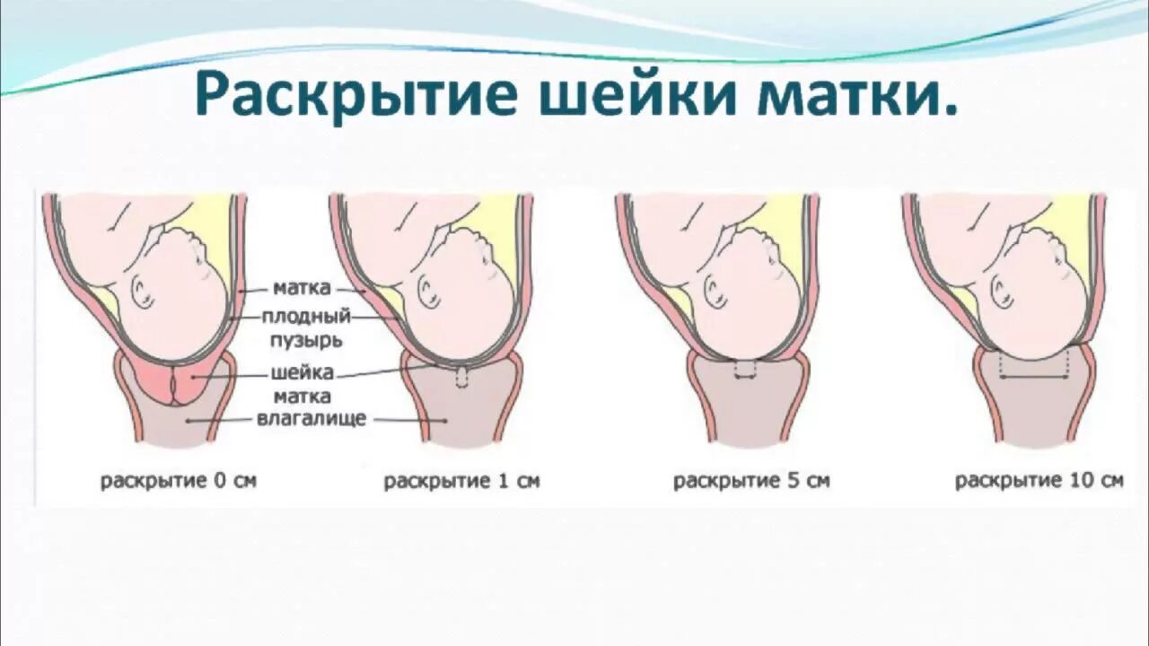 Этапы раскрытия шейки матки в родах. Периоды родов раскрытие шейки матки у повторнородящих. Шейка матки при беременности раскрытие. Раскрытие шейной матки. Первый этап родов