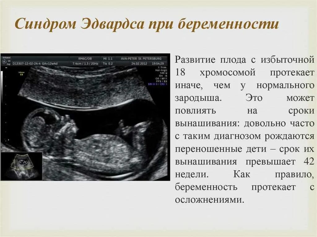 На 12 недель узи ребенка с синдромом дауна. Узи плода с синдромом дауна в 12 недель. Синдром дауна на узи 12 недель. Твп 12 недель синдром дауна. Узи 1 триместр беременности синдром дауна.