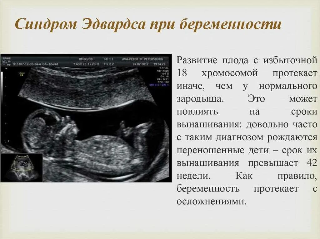 Диагноз 12 недель. Синдром Эдвардса УЗИ 1 скрининг. УЗИ признаки синдрома Дауна у плода. УЗИ плода с синдромом Эдвардса. УЗИ ребенка с синдромом Эдвардса.