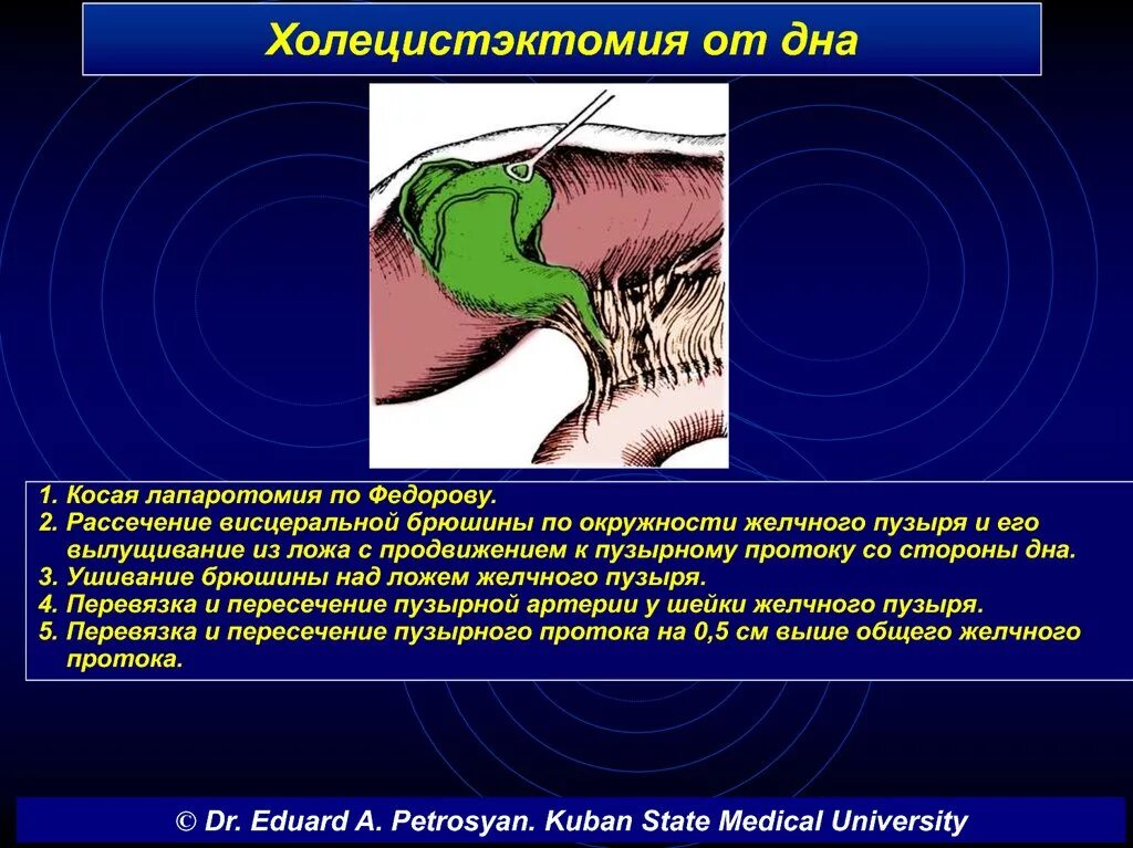 Антероградная холецистэктомия. Операция при ЖКБ ход операции. Холецистэктомия от дна и от шейки.