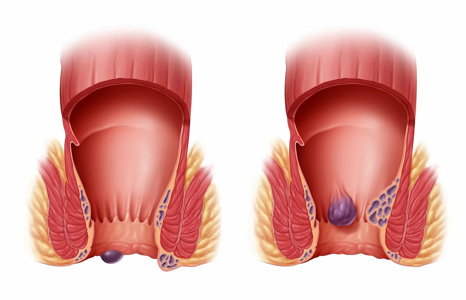 Трещины прохода. Наружный геморрой тромбоз. Геморрой узел наружный тромбоз. Тромбированный узел геморрой. Комбинированный (наружный и внутренний) геморрой 2 стадии..