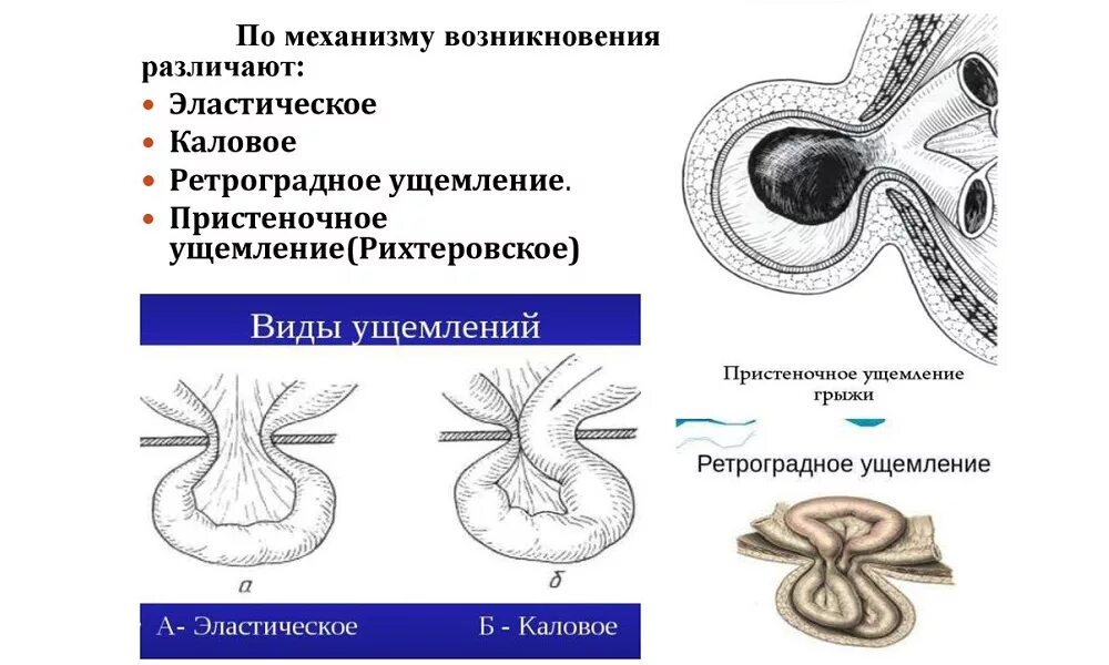 Лечение ущемленной грыжи. Ущемленная паховая грыжа классификация. Ущемленная паховая грыжа механизмы ущемления. Пристеночное ущемление паховой грыжи. Ущемленная паховая грыжа клиническая картина.