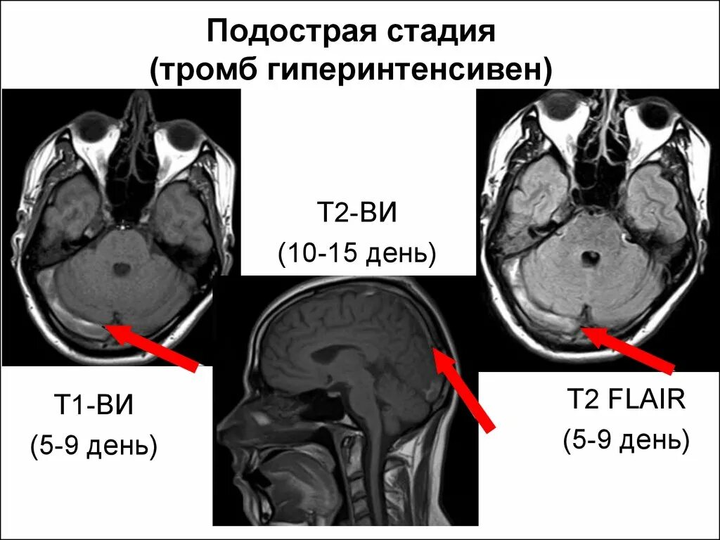 Мрт тромбоз. Т2 Flair на мрт. Гиперинтенсивного МР-сигнала. Очаги гиперинтенсивного по т2 и Flair. Т2 и т1 ви мрт что это.