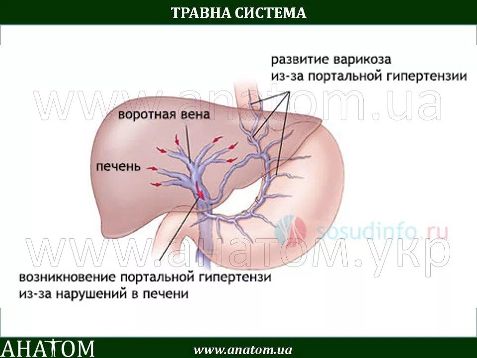 Синдром портальной гипертензии голова медузы. Варикозное расширение воротной вены. Симптомы портальной гипертензии голова медузы. Признаки портальной гипертензии. Печень расширены вены