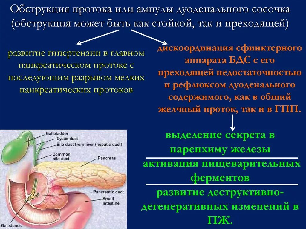 Панкреатит при удаленном желчном. Опухоль большого дуоденального сосочка. Опухоль дуоденальный сосочек. Обтурация протоков поджелудочной железы. Опухоль большой дуоденальный сосочек это.