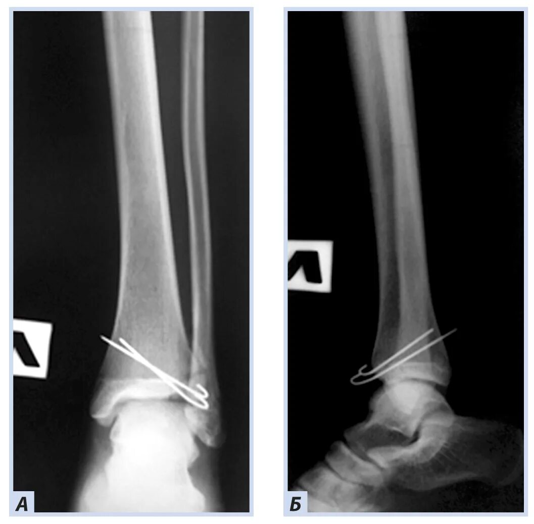 Оскольчатый перелом дистального метаэпифиза большеберцовой кости. Малоберцовая кость рентген анатомия. Перелом метафиза малоберцовой кости. Перелом большеберцовой кости и малоберцовой кости. Операция малоберцовой кости