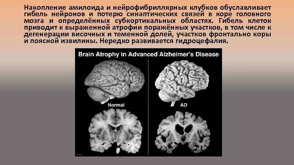 Атрофия головного мозга патанатомия. Атрофия коры головного мозга. Гибель клеток головного мозга. Отмирание коры головного мозга. Диффузная атрофия головного мозга