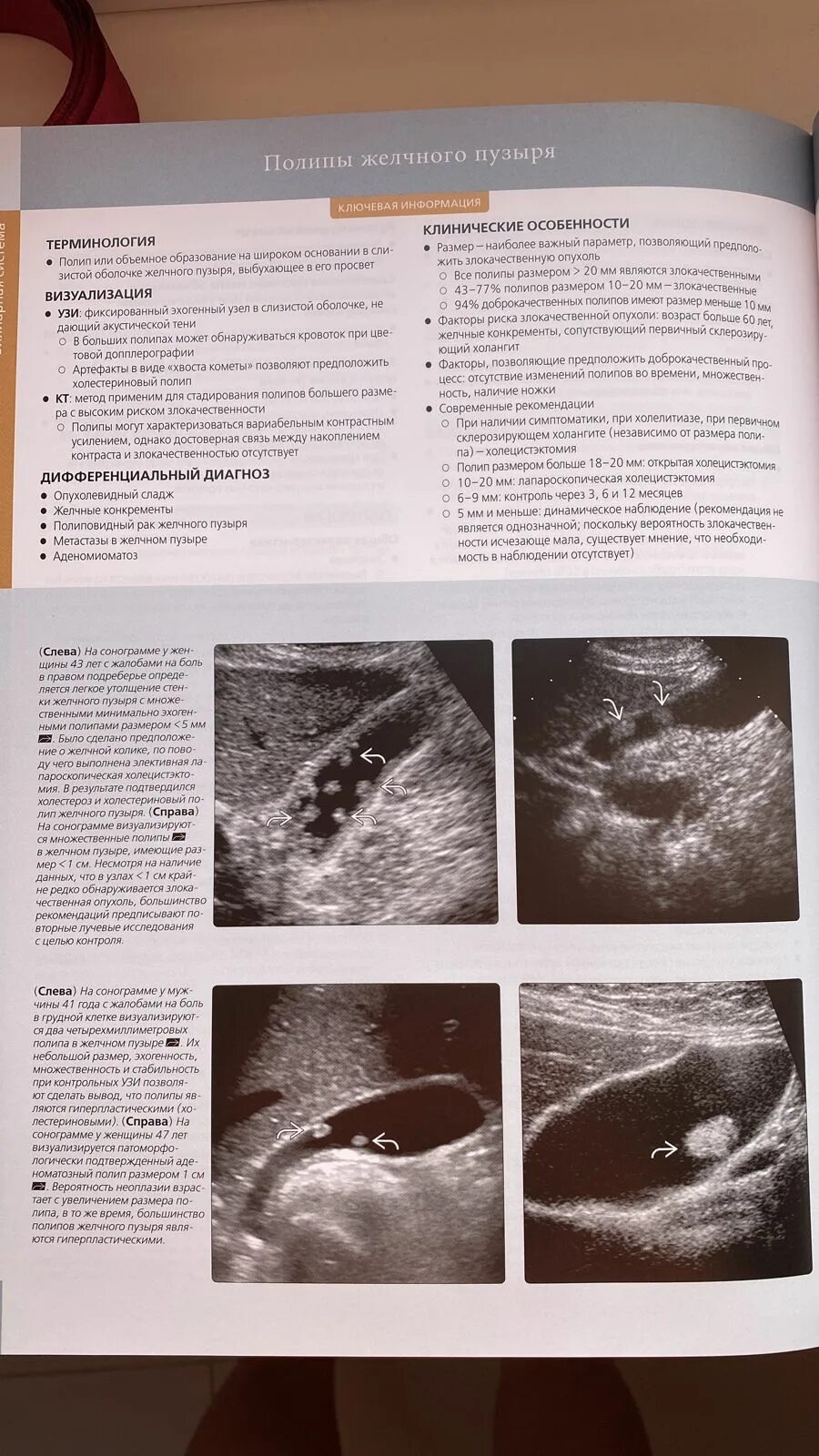 Полип желчного пузыря на УЗИ. Полпа желчного пузыря?. Полип желчного пузыря УЗИ заключение. Холестериновые полипы в желчном пузыре.