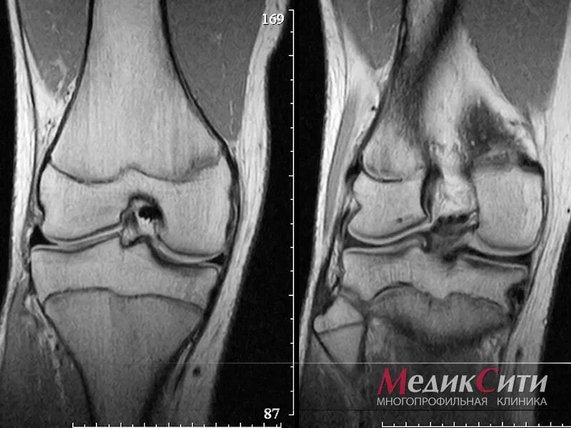 Мрт коленного сустава норма. Мрт коленного сустава патологии. Мрт колена.