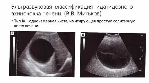 Киста в печени на узи что значит