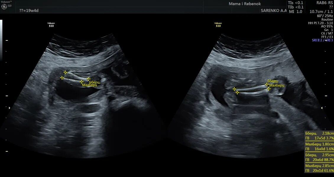 УЗИ 19-20 недель беременности. УЗИ на 19 неделе беременности пол. Фото УЗИ 19-20 недель беременности. 19 неделя 2023
