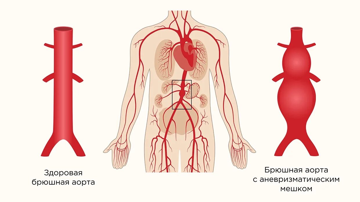 Аневризма аорты симптомы у женщин. Аневризма брюшного отдела аорты. Аневризма брюшной аорты классификация. Типы аневризм брюшной аорты.