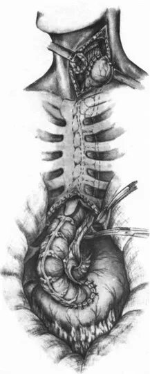 пищевод из толстой кишки. пищевод из толстой кишки. эзофагопластика по ру герцену юдину. толстокишечная пластика пищевода. современные методы пластики пищевода.