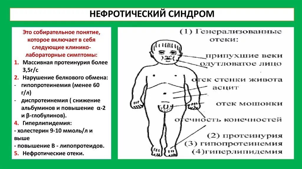 Нефротический синдром клинические проявления. Клинические проявления нефротического синдрома. Нефрититческий синдром. Нефротический синдром у детей.