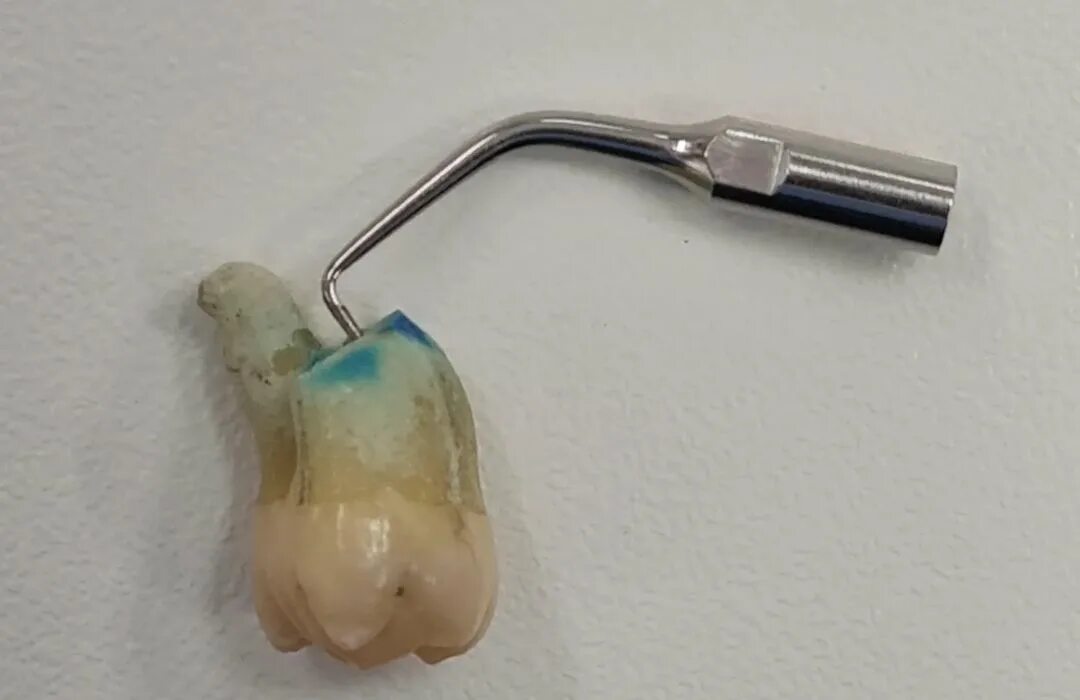 Cuanto dura un diente con endodoncia