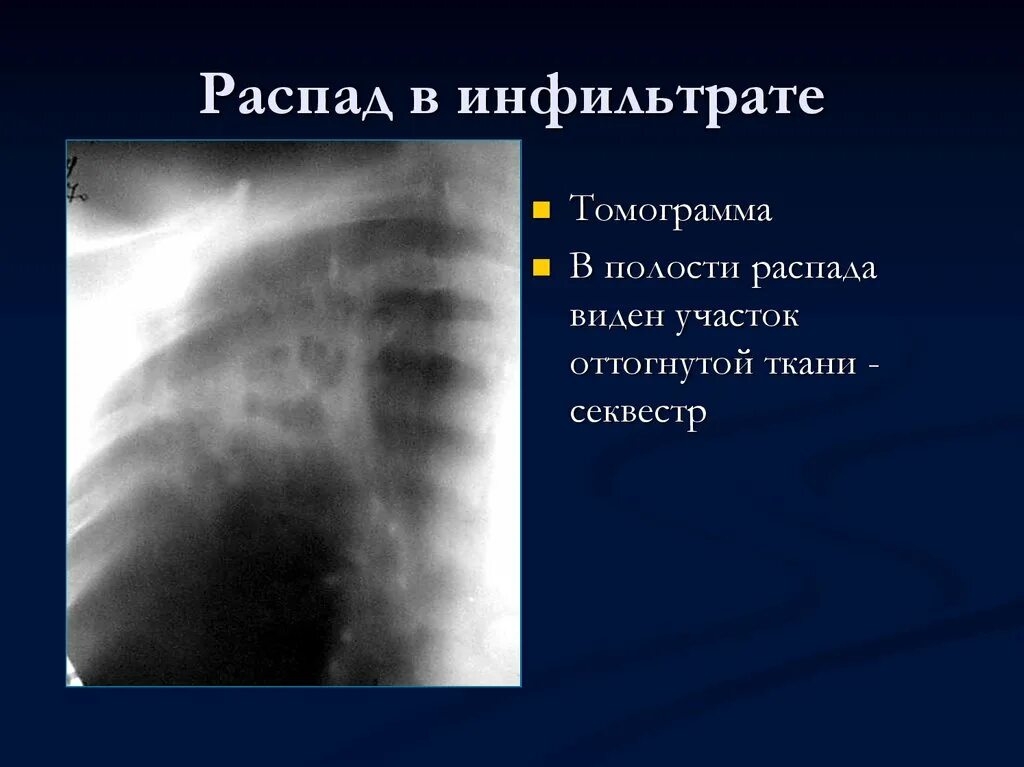 Участок распада. Инфильтрат с полостью распада. Полость распада на рентгене. Полость распада при туберкулезе. Полости распада при туберкулезе на рентгенограмме.