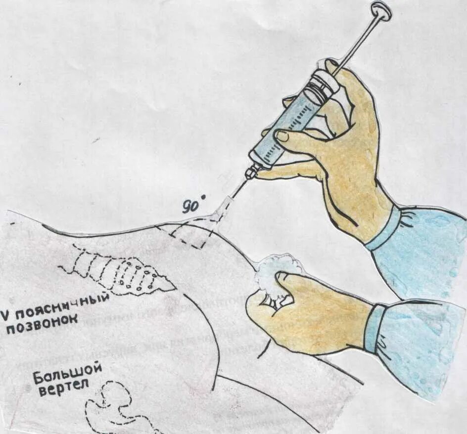 Как не больно сделать укол в ягодицу. Инъекции внутримышечно. Как правильно ставить укол. Как сделать укол. Как держать шприц.