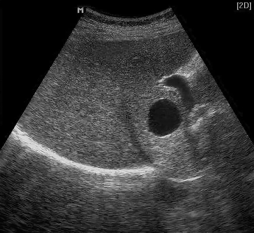 Мелкие кисты печени. Пневмобилия печени на УЗИ. Пневмобилия желчных протоков УЗИ. Пневмобилия желчного пузыря на УЗИ.