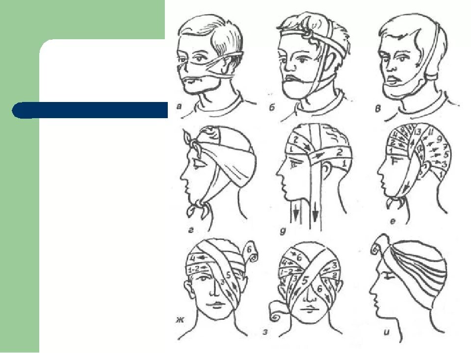 Как перевязывать голову. Пращевидная повязка на голову бинтом. Виды перевязок и способы их наложения. Десмургия пращевидная повязка. Наложение повязки при черепно-мозговой травме.