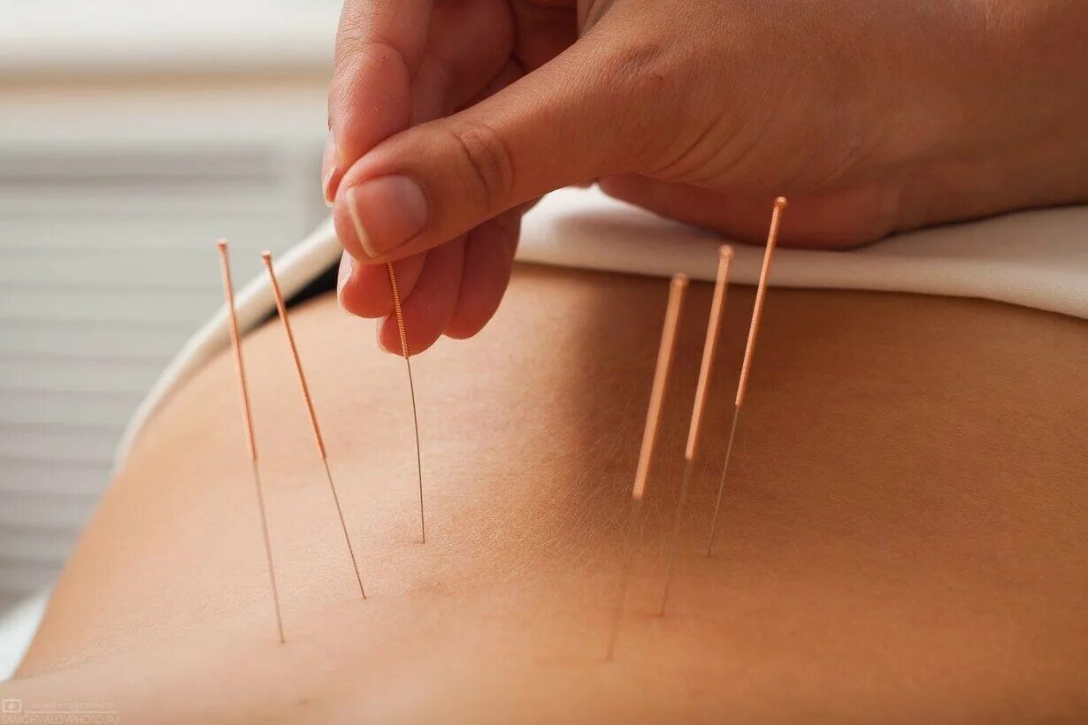 Хирургическая игла с нитью. Алгоритм вдевания нитки в иголку. Инструментарий для наложения и снятия швов. Технология выполнения шва вперед иголку. Стежок шов вперед иголка.