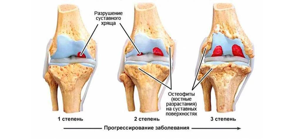 Остеофиты что это такое и как лечить. Остеофиты коленного сустава. Деформирующий артроз 2 степени.