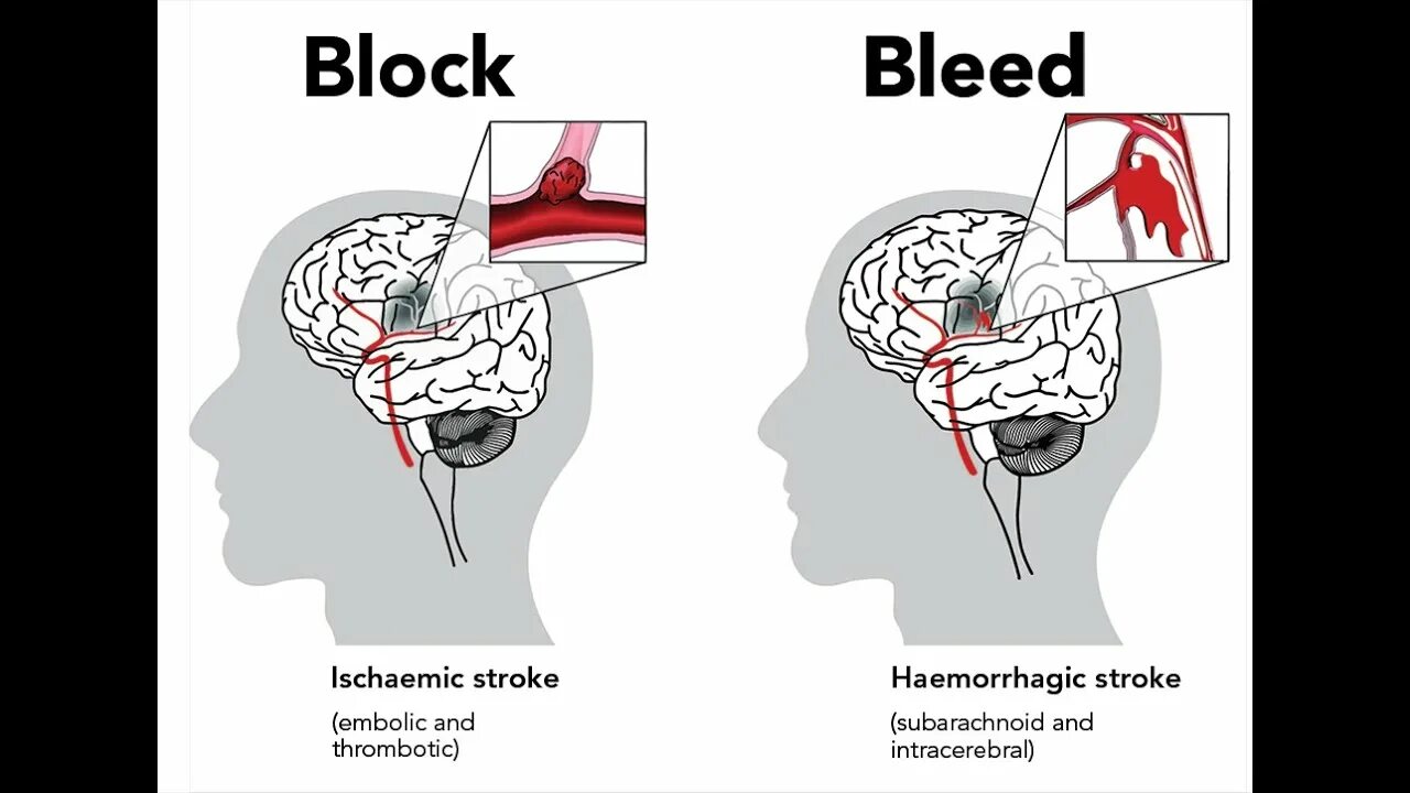 Инсульт ютуб. Stroke ютуб. What is stroke. Differences of hemorrhagic stroke and ischemic stroke.