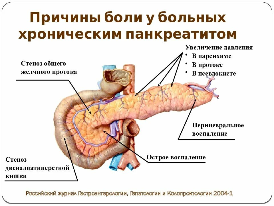Панкреатит проходит. Острый панкреатит поджелудочной железы. панкреатический проток псевдокиста. хронический панкреатит. причины хронического панкреатита.