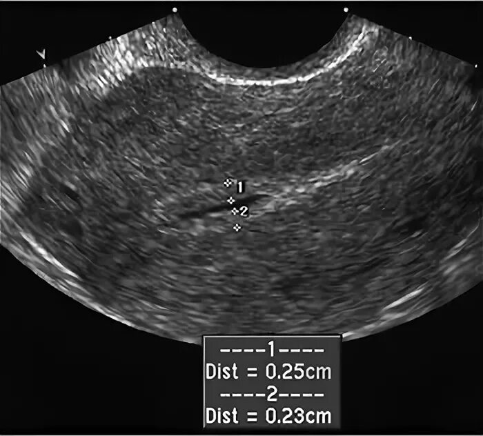 Синехия в полости матки на УЗИ. Синехии эндометрий на УЗИ. Синехии в полости матки на УЗИ. Эндометрия 25