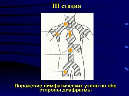 Поражение лимфатических узлов