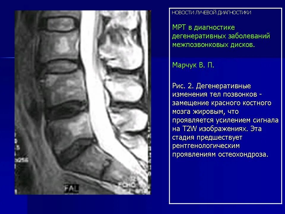 Жировая дистрофия костного мозга в телах позвонков. Жировая дегенерация позвонков на мрт что это. Жировая инфильтрация костного мозга. Костный мозг в телах позвонков дистрофически Изменен.