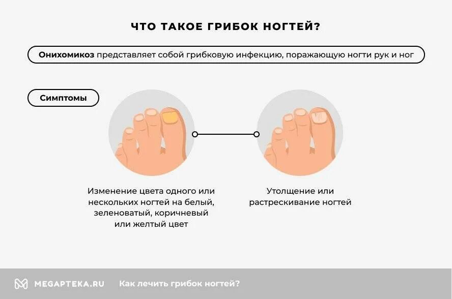 Сдать на какие грибки. Грибковые заболевания ногтей схема. При какой температуре погибает грибок ногтей. Схема лечения грибка ногтей на ногах.