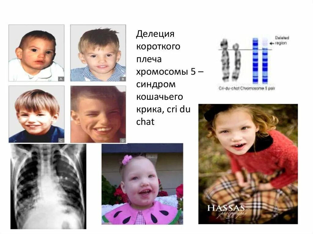 Микроделеция