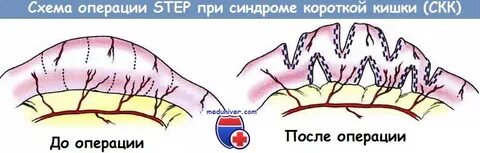 Операция на кишечнике отзывы