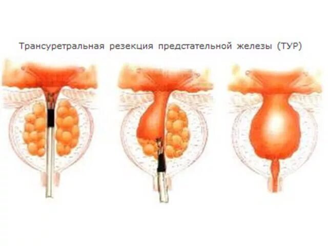 Тур урология. Тур трансуретральная резекция аденомы предстательной железы. Энуклеация аденомы предстательной железы. Трансуретральная резекция мочевого пузыря. Трансуретральная резекция гиперплазии предстательной железы.