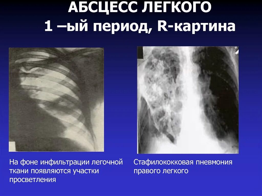 После абсцесса легкого. Инфильтрация легочной ткани. Рентгенография абсцесса легкого. Абсцесс легкого рентген.