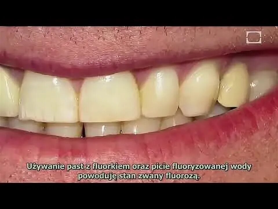 FAQ - What is the pinhole graft procedure? Friendswood Dental Group - YouTube