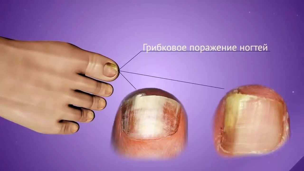 Лечение грибка ногтя врач. Гиперкератотический онихомикоз. Дистально латеральный онихомикоз. Грибок ногтей онихогрифоз. Онихомикоз ( обработка грибковых ногтей).