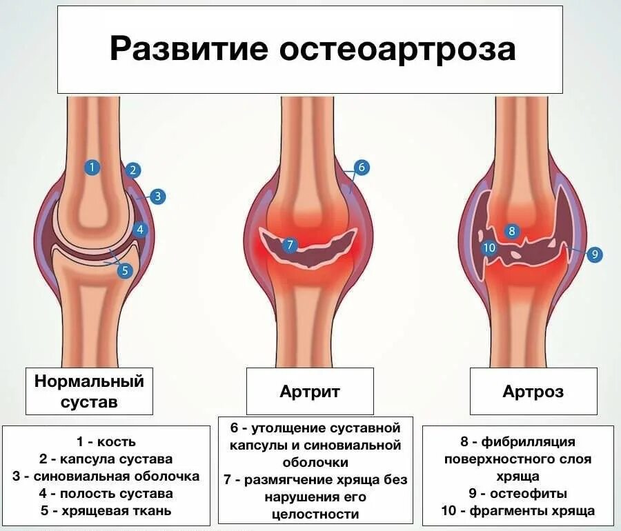 Артрит коленного сустава в домашних условиях. Схема развития деформирующего остеоартроза. Классификация остеоартроза коленного сустава. Деформирующий артроз коленного сустава схема. Первичный идиопатический остеоартроз.