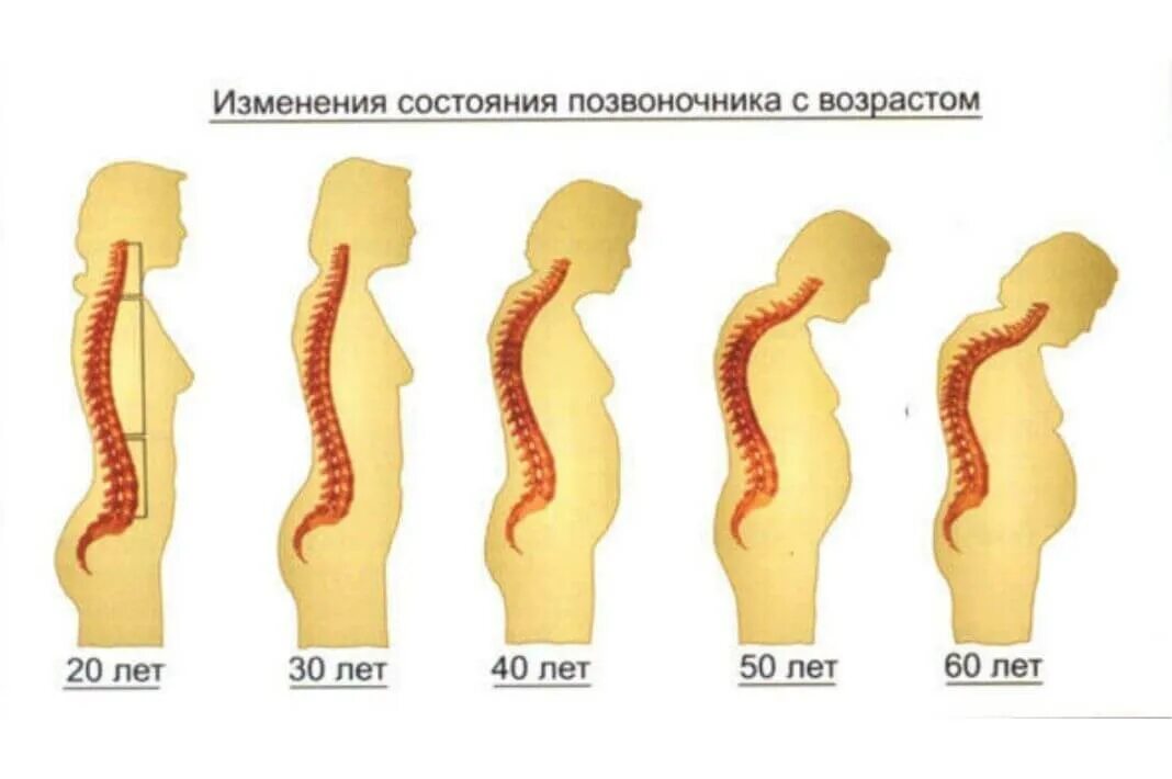 кифоз поясничного отдела позвоночника. кифоз у женщины. лордоз грудного отдела позвоночника. кифоз у женщины. кифоз у женщины.