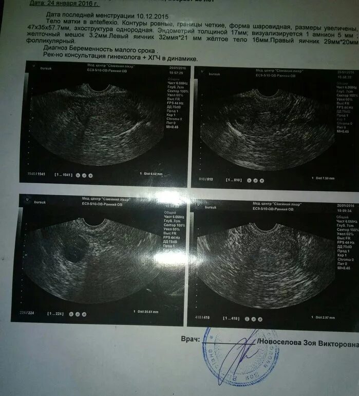 Жёлтое тело диаметром 5 мм. УЗИ беременности 5 недель эндометрий. УЗИ 4 недели беременности желтое тело.
