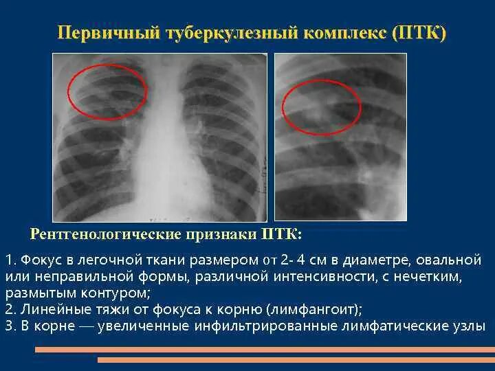 Стадия инфильтрации легких. Первичный туберкулезный комплекс у детей рентген. фаза биполярности первичный туберкулезный комплекс. первичный туберкулезный комплекс в фазе инфильтрации. первичный туберкулезный комплекс описание рентгенограммы.