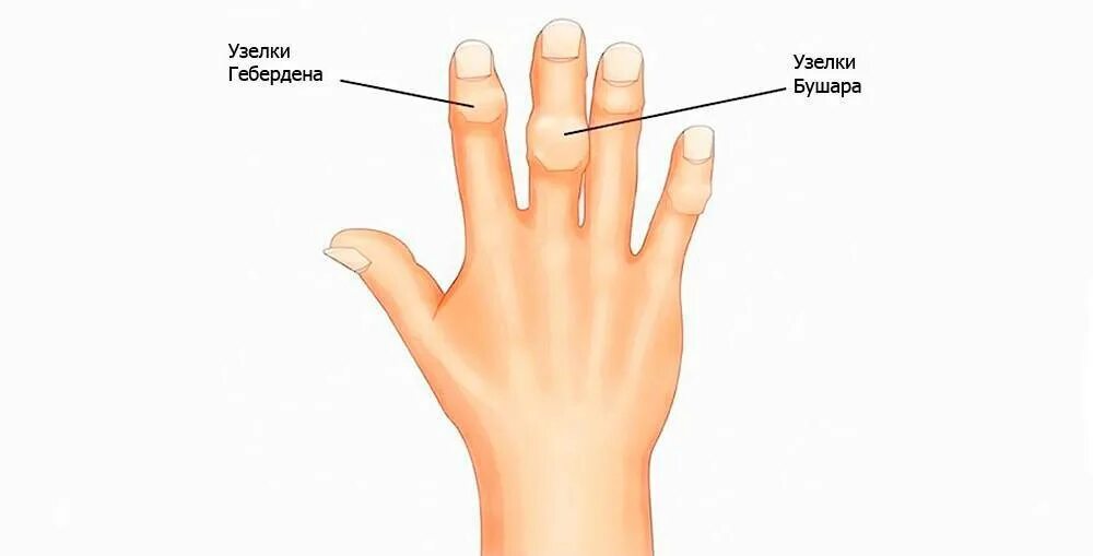 Узелки на руке что это. Красная нить с узелками на запястье. Шерстяная нитка на запястье. Узелки бушара ревматоидный артрит. Узелки на руке что это.