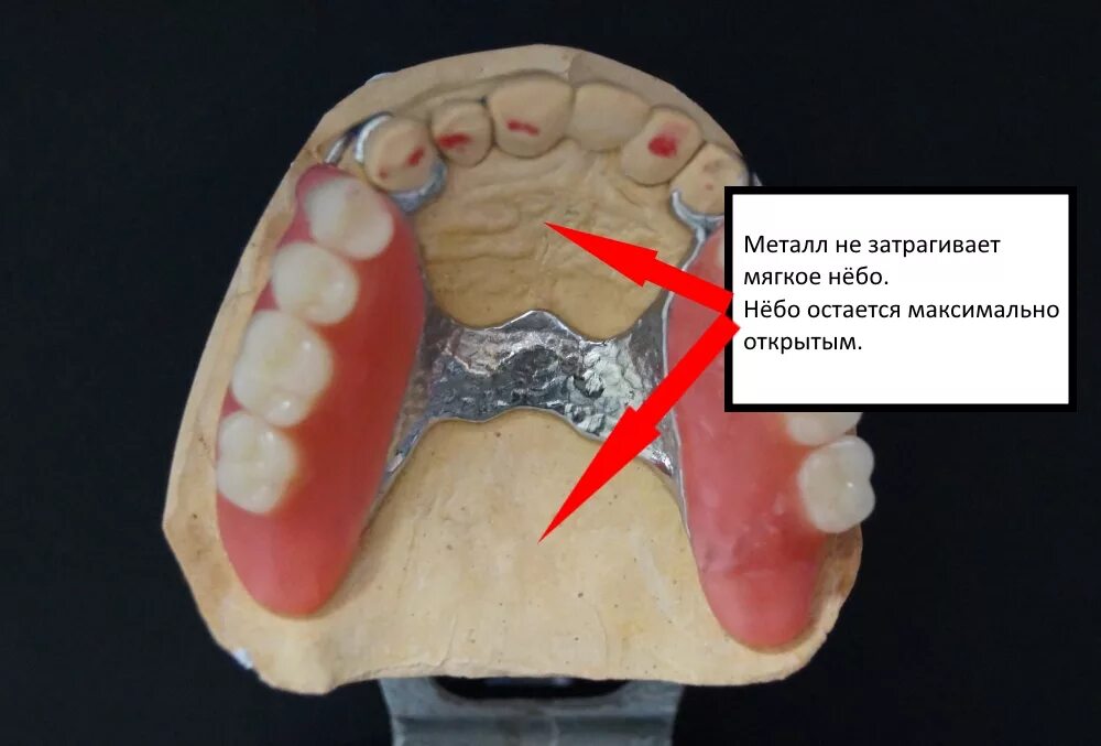 Нижняя дуга бюгельного протеза. Съемный бюгельный протез (1 челюсть). границы базиса бюгельного протеза на верхней и нижней челюсти. дуга бюгельного протеза на верхнюю челюсть. дуга бюгельного протеза.