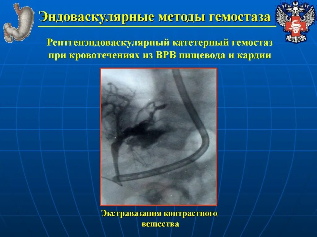 Что такое экстравазация