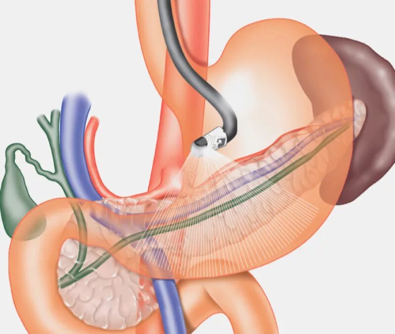 Двенадцатиперстная кишка ФГДС. Гастроскопия двенадцатиперстной кишки. ФГДС И желудочному зондированию.. Гастроскопия (ФГДС) желудка. Гастроскопия желудка что это