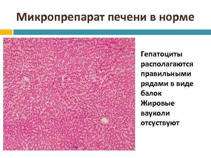 Печень микропрепарат описание. Жировой цирроз печени микропрепарат. Печень микропрепарат гистология. Гепатоциты строение гистология. Мускатная печень патанатомия макропрепарат.