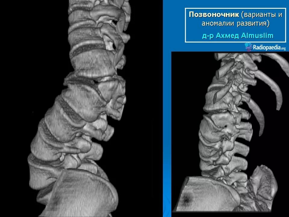 Врождённая аномалия позвонков (клиновидные позвонки). Конкресценция шейных позвонков рентген.