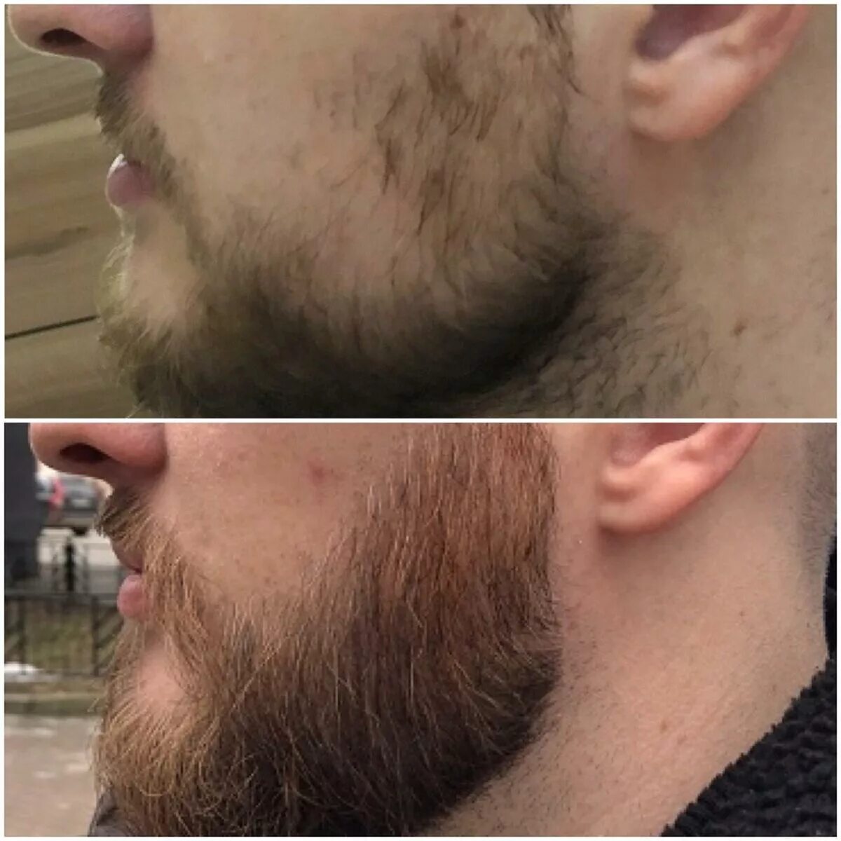 Почему появляется борода. Рыжая борода миноксидил. Формы отращивания бороды. Растительность на лице у мужчин. Рост бороды.